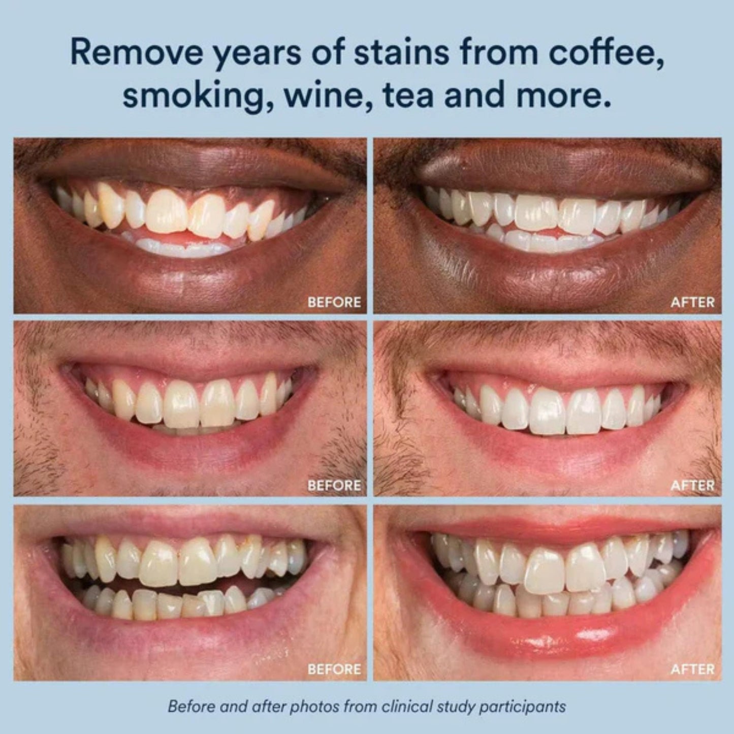 Lip Revitalising & Teeth Whitening Device