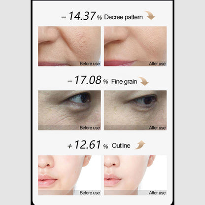 EMS+RF Facial Beauty Device Firming & Wrinkle Reduction